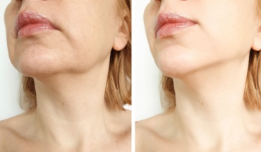 Facelift: Αποκατάσταση με φυσικό αποτέλεσμα, χωρίς υπερβολές