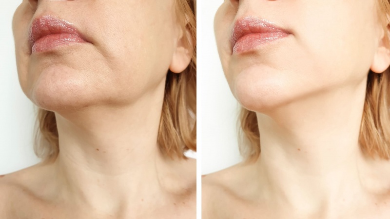 Facelift: &Alpha;&pi;&omicron;&kappa;&alpha;&tau;ά&sigma;&tau;&alpha;&sigma;&eta; &mu;&epsilon; &phi;&upsilon;&sigma;&iota;&kappa;ό &alpha;&pi;&omicron;&tau;έ&lambda;&epsilon;&sigma;&mu;&alpha;, &chi;&omega;&rho;ί&sigmaf; &upsilon;&pi;&epsilon;&rho;&beta;&omicron;&lambda;έ&sigmaf;