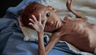 UNICEF:  Έκθεση σχεδόν 1 εκ. παιδιών σε οξύ υποσιτισμό