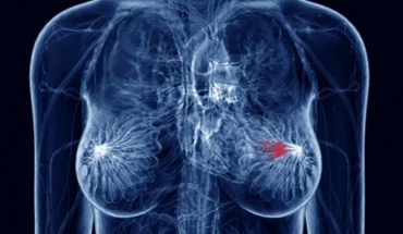 Υψηλά επίπεδα ρύπανσης του αέρα σχετίζονται με αυξημένη συχνότητα καρκίνου του μαστού