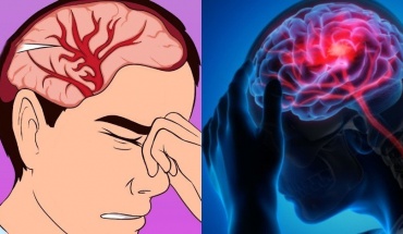 Αυτά είναι τα χαρακτηριστικά των ασθενών με Αγγειακό Εγκεφαλικό Επεισόδιο και COVID-19