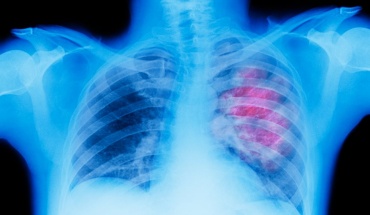 Νέα θεραπεία στην Ευρώπη για τον μεταστατικό καρκίνο του πνεύμονα