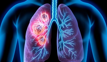 Νέο φάρμακο μειώνει τις πιθανότητες θανάτου από καρκίνο του πνεύμονα