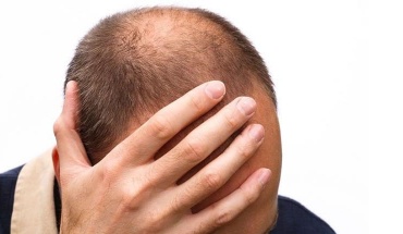 Γυροειδής αλωπεκία: Νέο "όπλο" για την αντιμετώπισή της