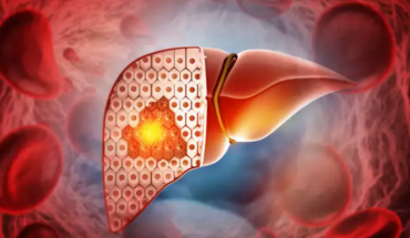 "Ένοχα" γονίδια για τη μεταβολικά σχετιζόμενη στεατωτική νόσο του ήπατος