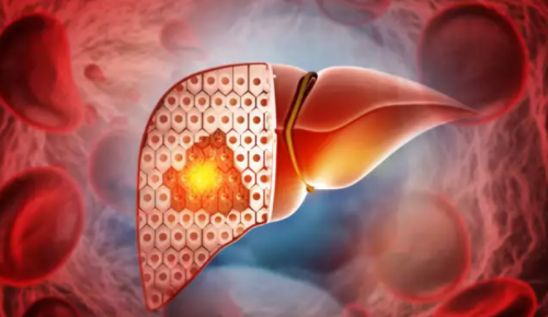 "Ένοχα" γονίδια για τη μεταβολικά σχετιζόμενη στεατωτική νόσο του ήπατος