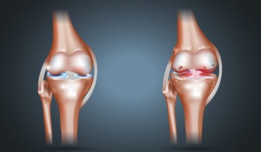 Οστεοαρθρίτιδα γόνατος και αεροβική άσκηση