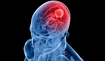 Φάρμακο για την αρτηριακή πίεση επιβραδύνει τον επιθετικό καρκίνο του εγκεφάλου