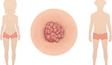 HPV- κονδυλώματα- καρκίνος τραχήλου μήτρας: Μία αλυσίδα που μπορούμε να σπάσουμε