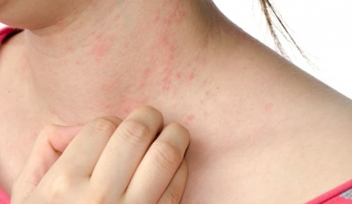 Το έκζεμα ενεργοποιείται από το άγχος: Βρέθηκε ο μηχανισμός