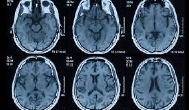 Η πρώιμη διάγνωση του Αλτσχάιμερ γίνεται με μαγνητική τομογραφία