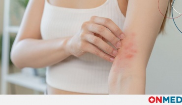 Το έκζεμα δυσκολεύει τη ζωή των νέων σε όλα τα μήκη και πλάτη της Γης