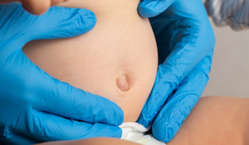 Ομφαλοκήλη: Αίτια, συμπτώματα, παράγοντες κινδύνου και θεραπεία