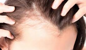 Μεγάλο το άγχος και η πίεση για γυναίκες με αραίωση στα μαλλιά και ανάγκη για μεταμόσχευση