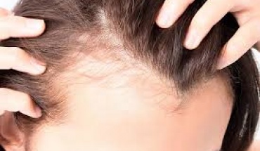 Μεγάλο το άγχος και η πίεση για γυναίκες με αραίωση στα μαλλιά και ανάγκη για μεταμόσχευση