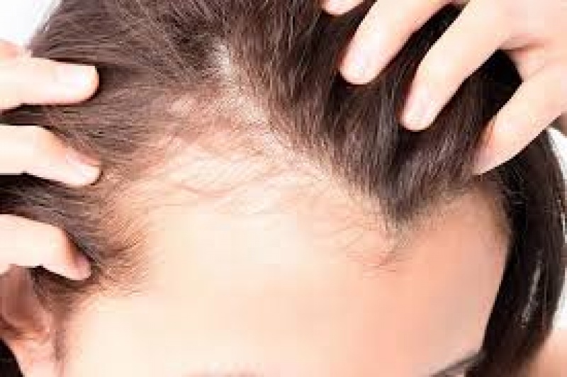 Μεγάλο το άγχος και η πίεση για γυναίκες με αραίωση στα μαλλιά και ανάγκη για μεταμόσχευση