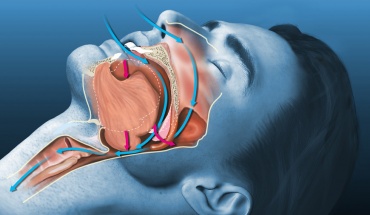 Υπνική άπνοια: Πώς την αναγνωρίζουμε και τι προκαλεί