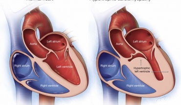 Αιφνίδιος θάνατος σε αθλητές και υπερτροφική μυοκαρδιοπάθεια