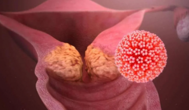 Το εμβόλιο κατά του HPV έχει σώσει ήδη μία γενεά νέων από τους συναφείς καρκίνους