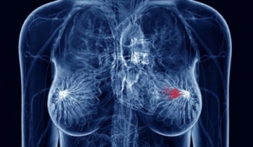 Όφελος της ορμονικής θεραπείας σε προεμμηνοπαυσιακές ασθενείς με καρκίνο μαστού