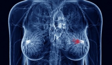 Όφελος της ορμονικής θεραπείας σε προεμμηνοπαυσιακές ασθενείς με καρκίνο μαστού