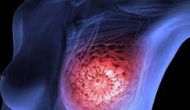 Εξατομίκευση των θεραπευτικών επιλογών στον τριπλά αρνητικό καρκίνο μαστού