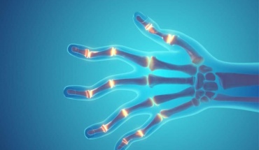 Εμμηνόπαυση και ρευματικά νοσήματα: Μία σιωπηλή κρίση που απαιτεί άμεση δράση