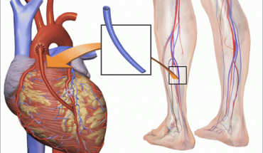 Τι είναι η στεφανιαία νόσος;