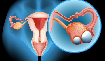Καρκίνος των ωοθηκών: Ο ύπουλος εχθρός των γυναικών στην εμμηνόπαυση
