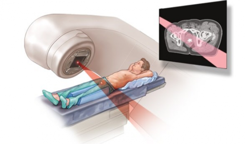 Aνδρογονικός αποκλεισμός και ριζική ακτινοθεραπεία η λύση για τον εντοπισμένο καρκίνο προστάτη