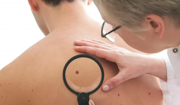 Ιοί που ευθύνονται για καρκίνο του δέρματος και πώς προλαμβάνουμε τη νόσο