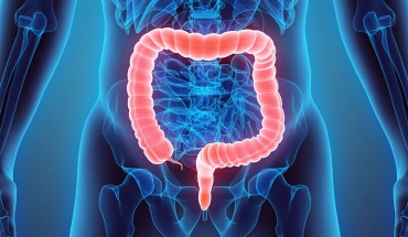 Καρκίνος παχέος εντέρου: Γιατί αυξάνεται στα άτομα κάτω των 50;