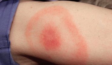 Νόσος Lyme: Τι είναι και πώς θεραπεύεται