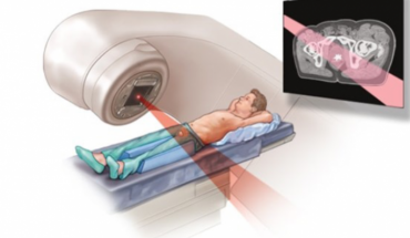 Aνδρογονικός αποκλεισμός και ριζική ακτινοθεραπεία η λύση για τον εντοπισμένο καρκίνο προστάτη