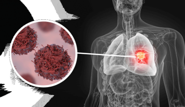 Αναπτύσσουν εισπνεόμενο τεστ ελέγχου για τον καρκίνο του πνεύμονα