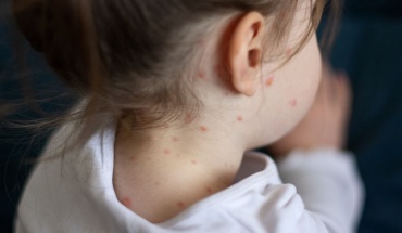 Βρετανία: Προειδοποίηση για επανεμφάνιση ιλαράς