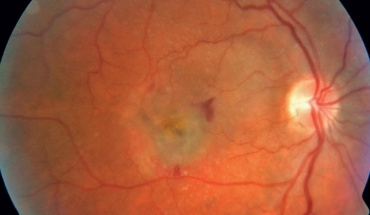 Ηλικιακή εκφύλιση ωχράς κηλίδας και θεραπεία για το διαβήτη τύπου 2