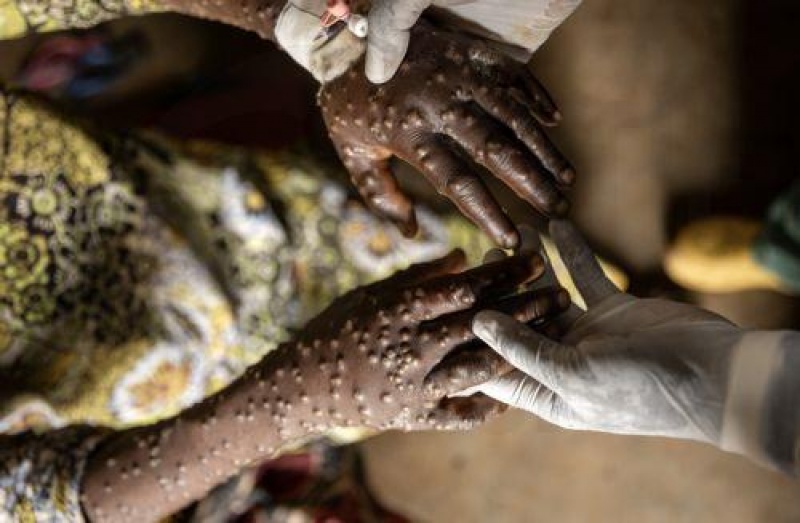 Καταγράφηκε ο πρώτος θάνατος στη Γκάνα από mpox