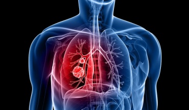 Μετασταστικός μη μικροκυτταρικός καρκίνος πνεύμονα: Καλά νέα από την Bristol