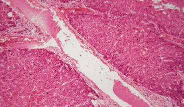 Πανελλήνιο Συνέδριο και Παγκόσμια Ημέρα Σπάνιων Παθήσεων: Εξελίξεις στην αμυλοείδωση