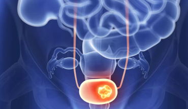 Νέα θεραπευτική επιλογή για τον μυοδιηθητικό καρκίνο της ουροδόχου κύστης