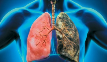 Τι είναι ο καρκίνος του πνεύμονα;