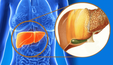 Δρ. Χατζημπέη: Νέα ασθένεια της εποχής το λιπώδες ήπαρ