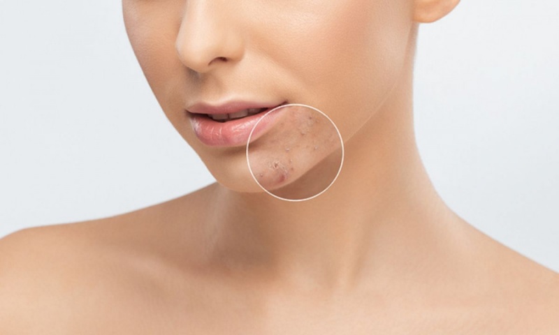 Η σχέση της ακμής με την κατανάλωση ζάχαρης