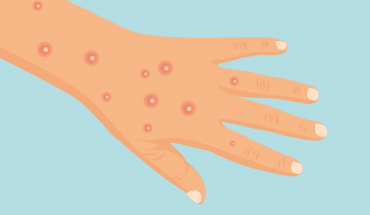 Mpox: Γιατί αυξάνονται τα κρούσματα στην Ευρώπη