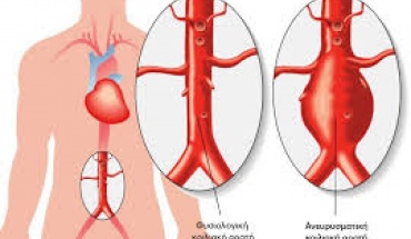 Τι είναι το ανεύρυσμα αορτής;