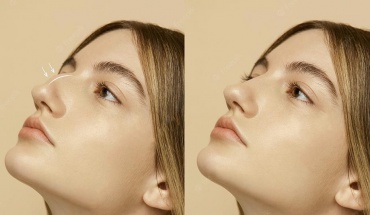 Τεχνολογία Piezo: Πώς αλλάζει τα δεδομένα στη ρινοπλαστική