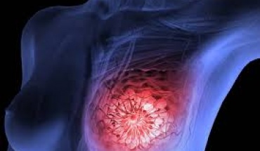 Ορισμένες ασθενείς με καρκίνο του μαστού μπορούν να επιβιώσουν χωρίς ακτινοθεραπεία